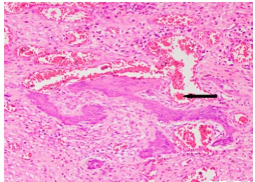 Esophagus, wall, osseous transformation of fibroblastic cells (arrow). H&amp;E x20.