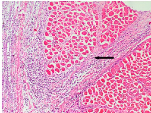 Subcutaneous tissue and intermuscular fascicles containing purulent exudates, necrotic areas with gradual constriction of overall muscle mass (arrow), H&amp;E x20.