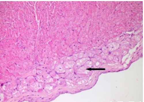Heart, vacuolar andgranular degeneration of purkinjee cells, H&amp;E x20