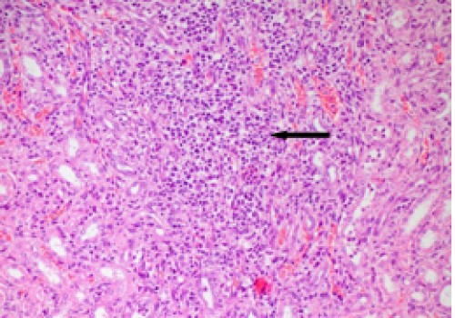 Kidney, distinct infiltration of lymphocytes, macrophages and lymphoblast in interstitium, H&amp;E x20